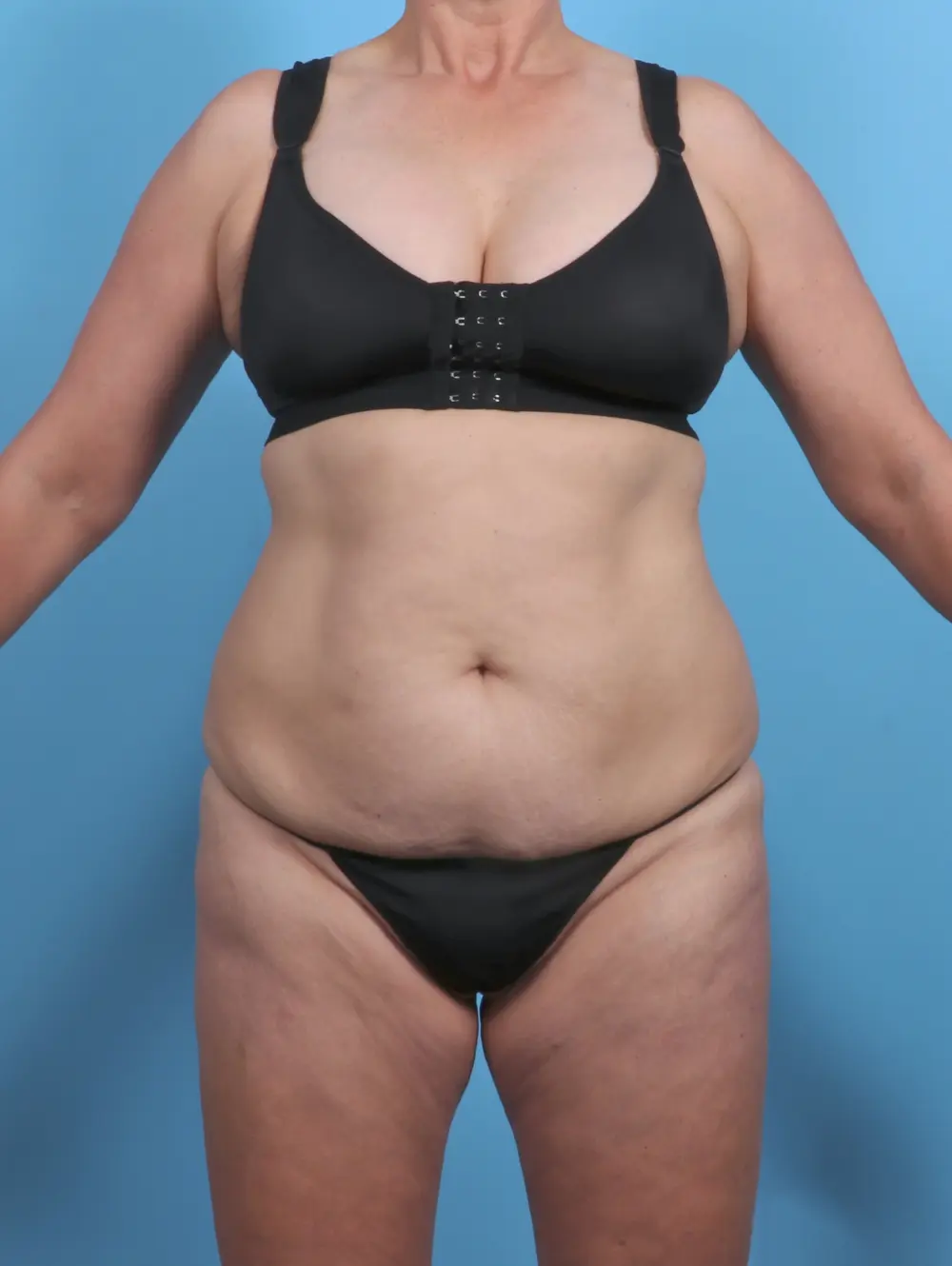 Tummy Tuck Patient Photo - Case 46356 - before view-