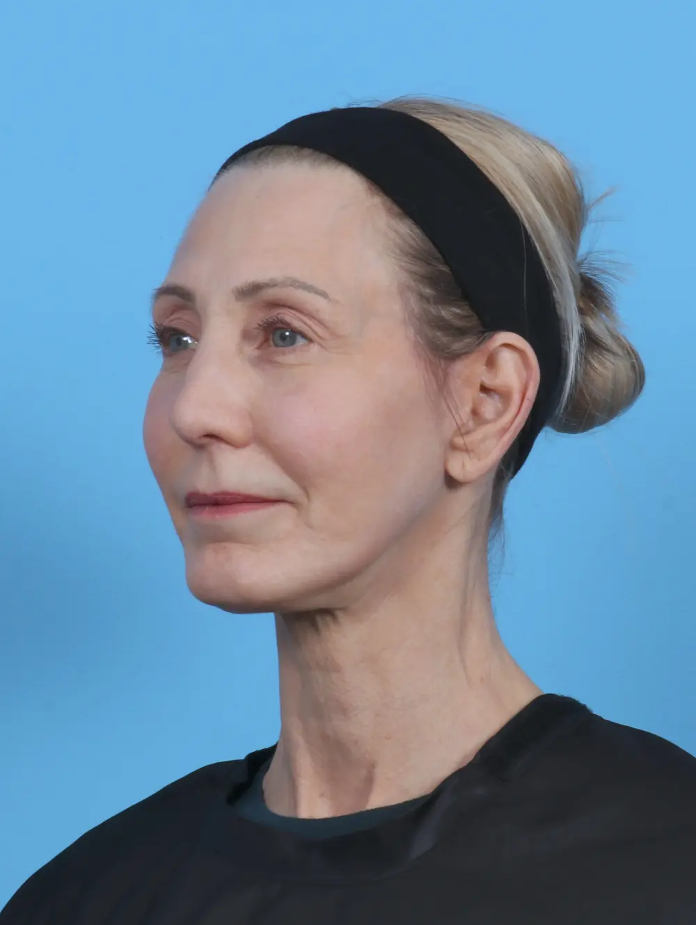 Facelift / Neck Lift Patient Photo - Case 46366 - after view-1