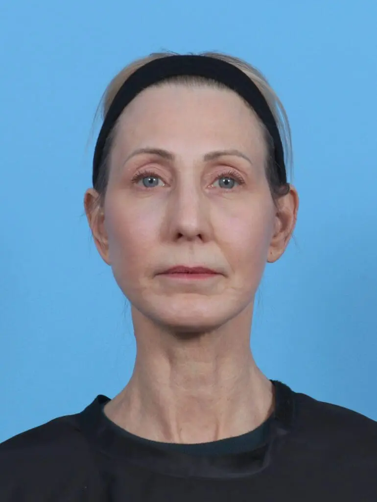 Facelift / Neck Lift - Case 46366 - After