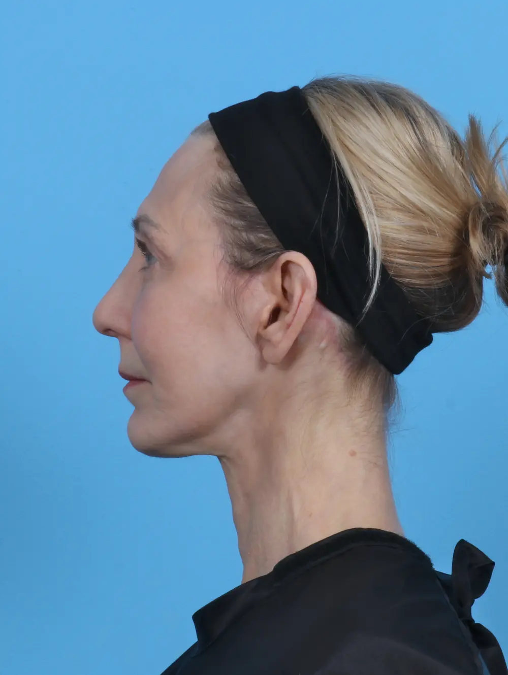 Facelift / Neck Lift Patient Photo - Case 46366 - after view-2