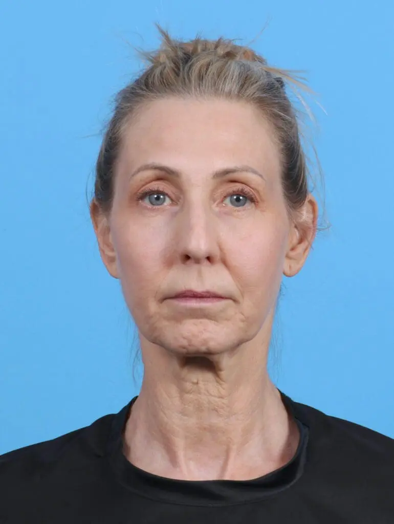 Facelift / Neck Lift - Case 46366 - Before