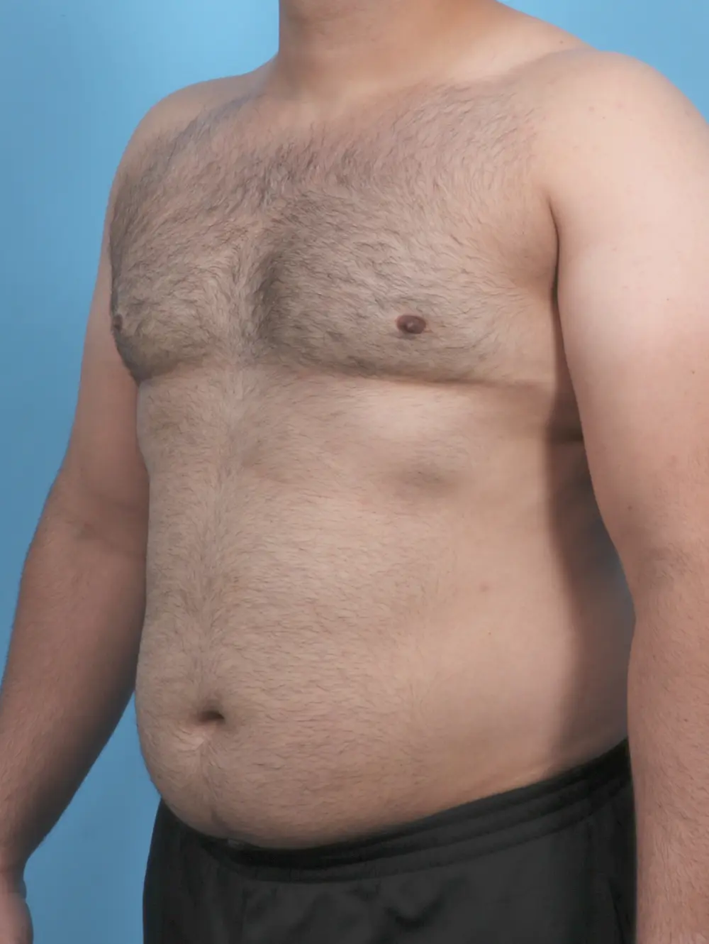 Gynecomastia Patient Photo - Case 46376 - after view-1