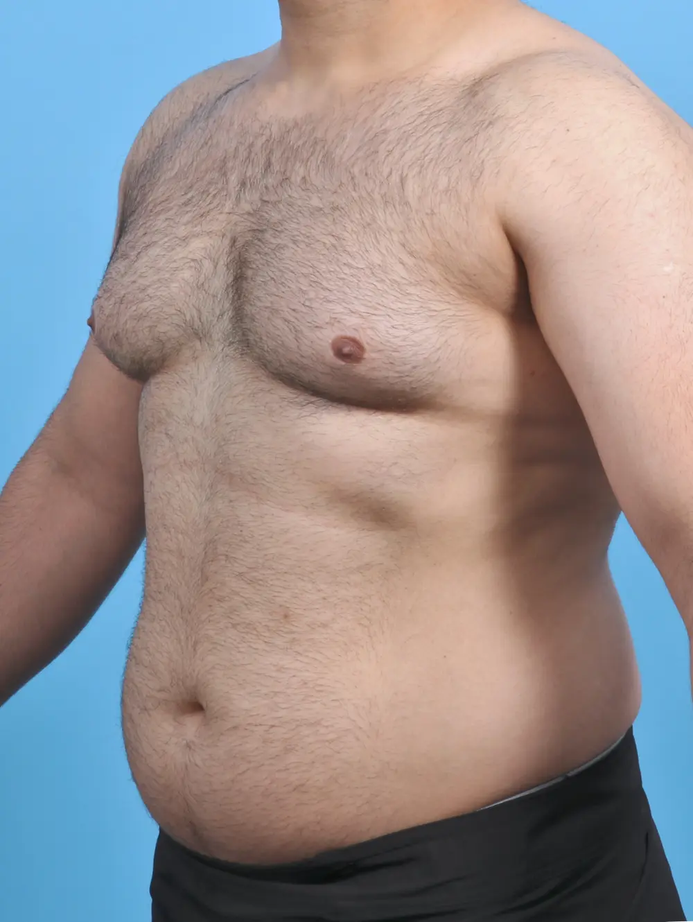 Gynecomastia Patient Photo - Case 46376 - before view-1