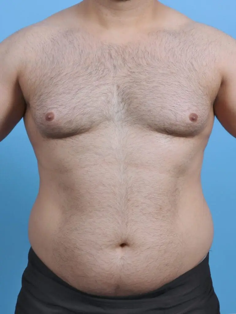 Gynecomastia - Case 46376 - Before