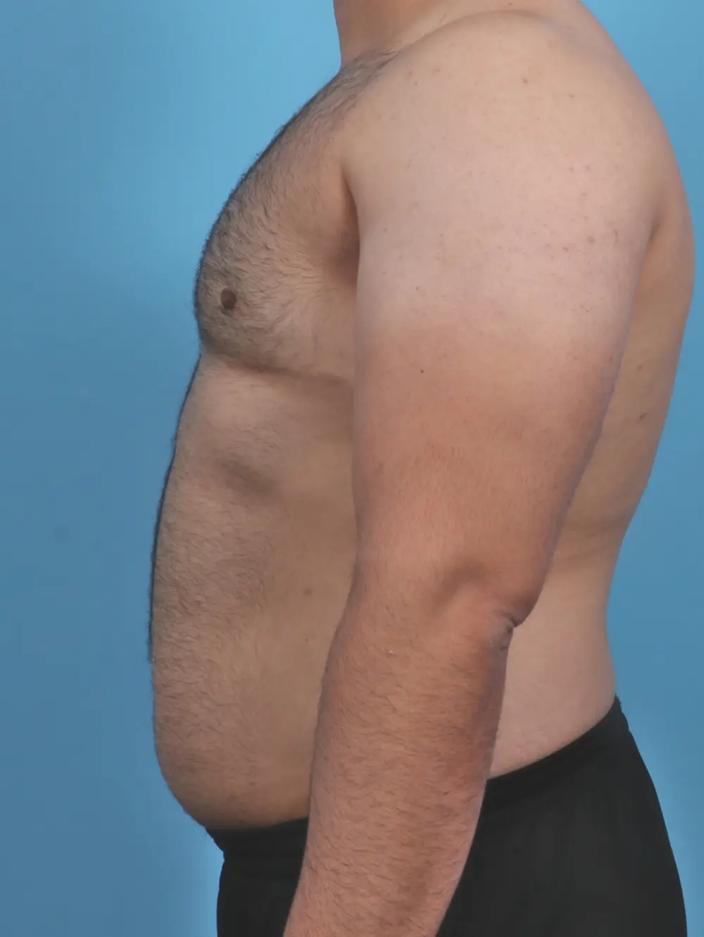 Gynecomastia Patient Photo - Case 46376 - after view-2