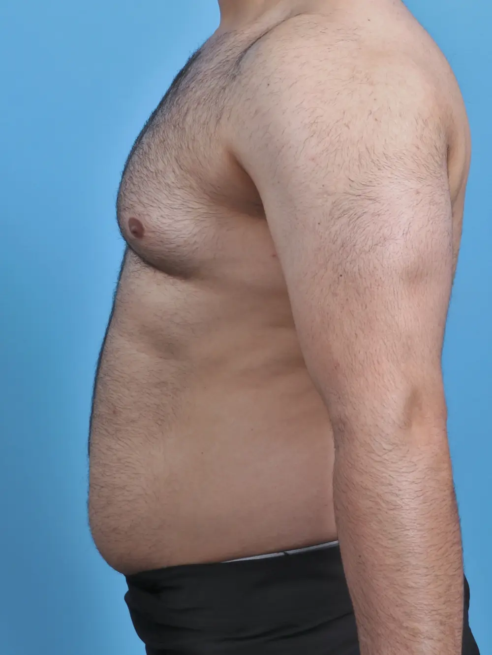 Gynecomastia Patient Photo - Case 46376 - before view-2