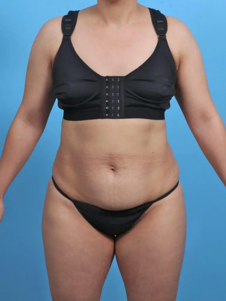 Tummy Tuck - Case 46384 - Before