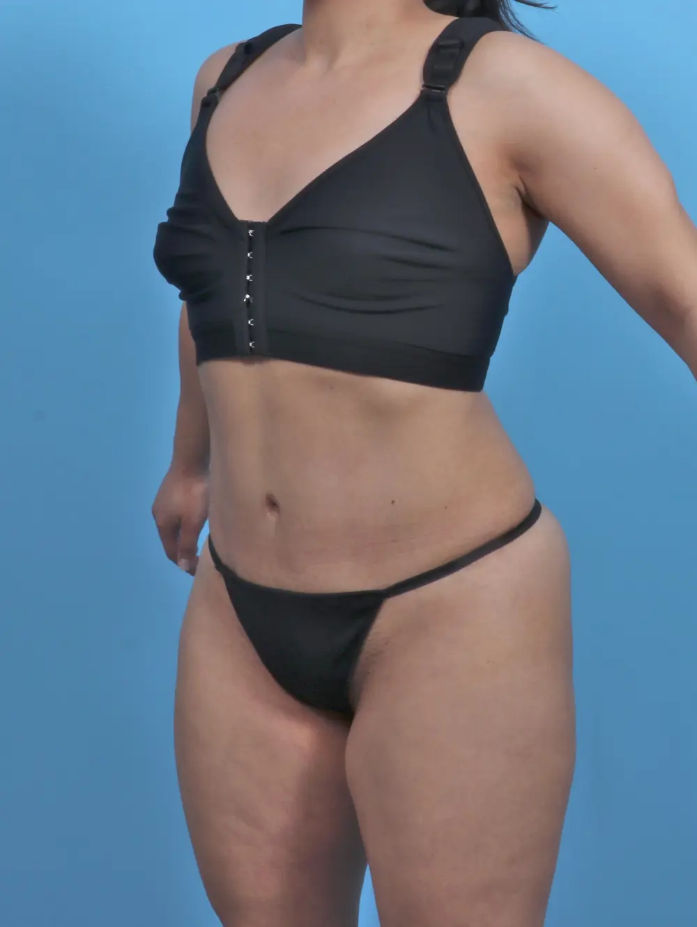 Tummy Tuck Patient Photo - Case 46384 - after view-1
