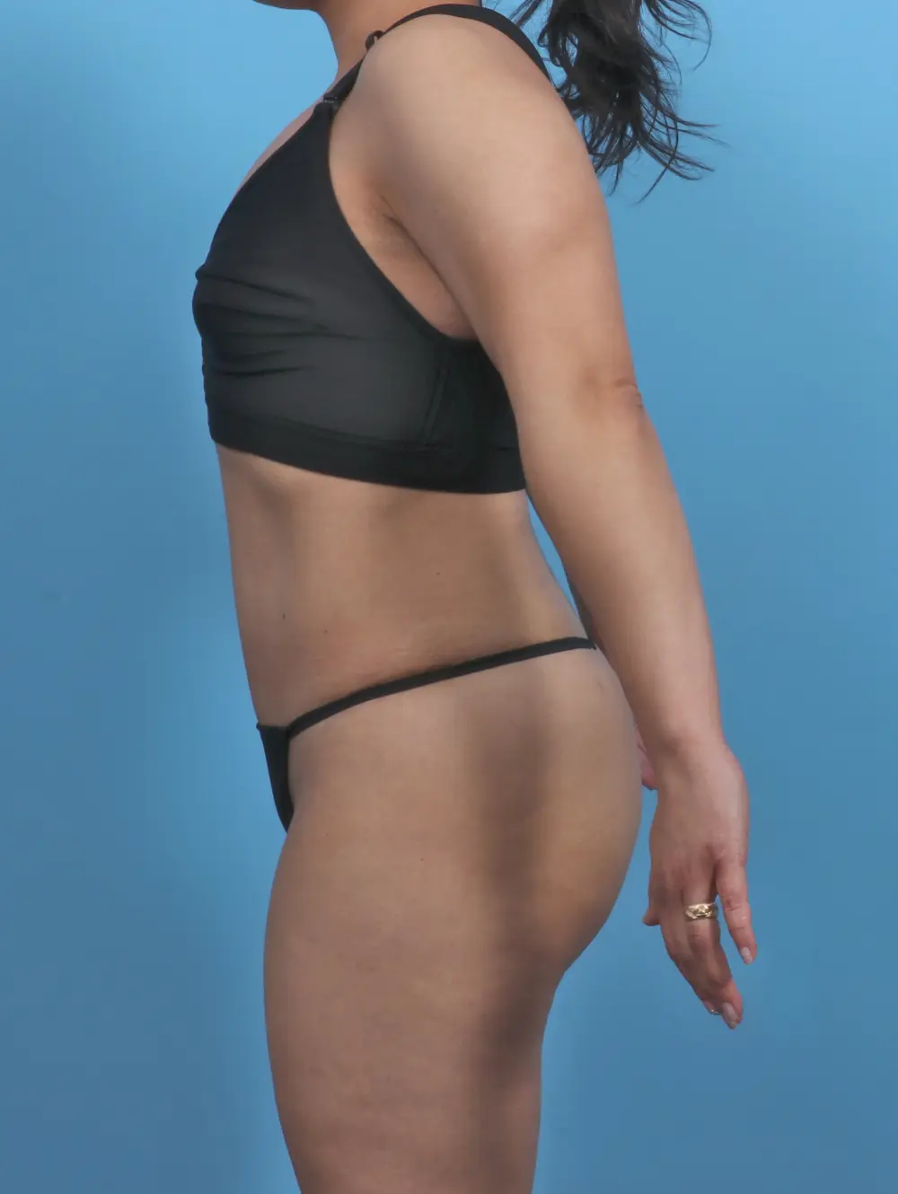 Tummy Tuck Patient Photo - Case 46384 - after view-2