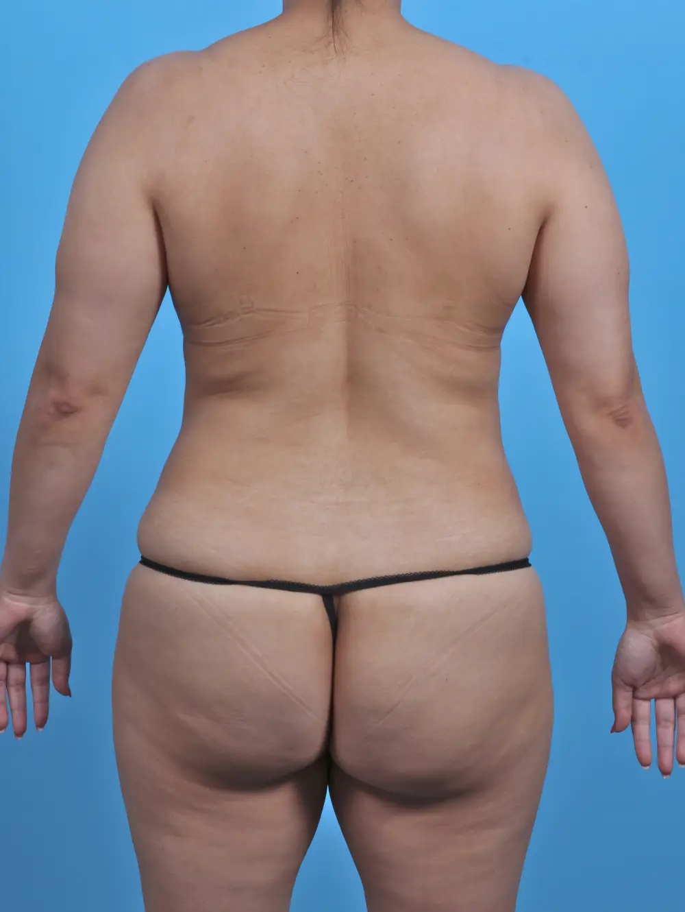 Tummy Tuck Patient Photo - Case 46384 - before view-3