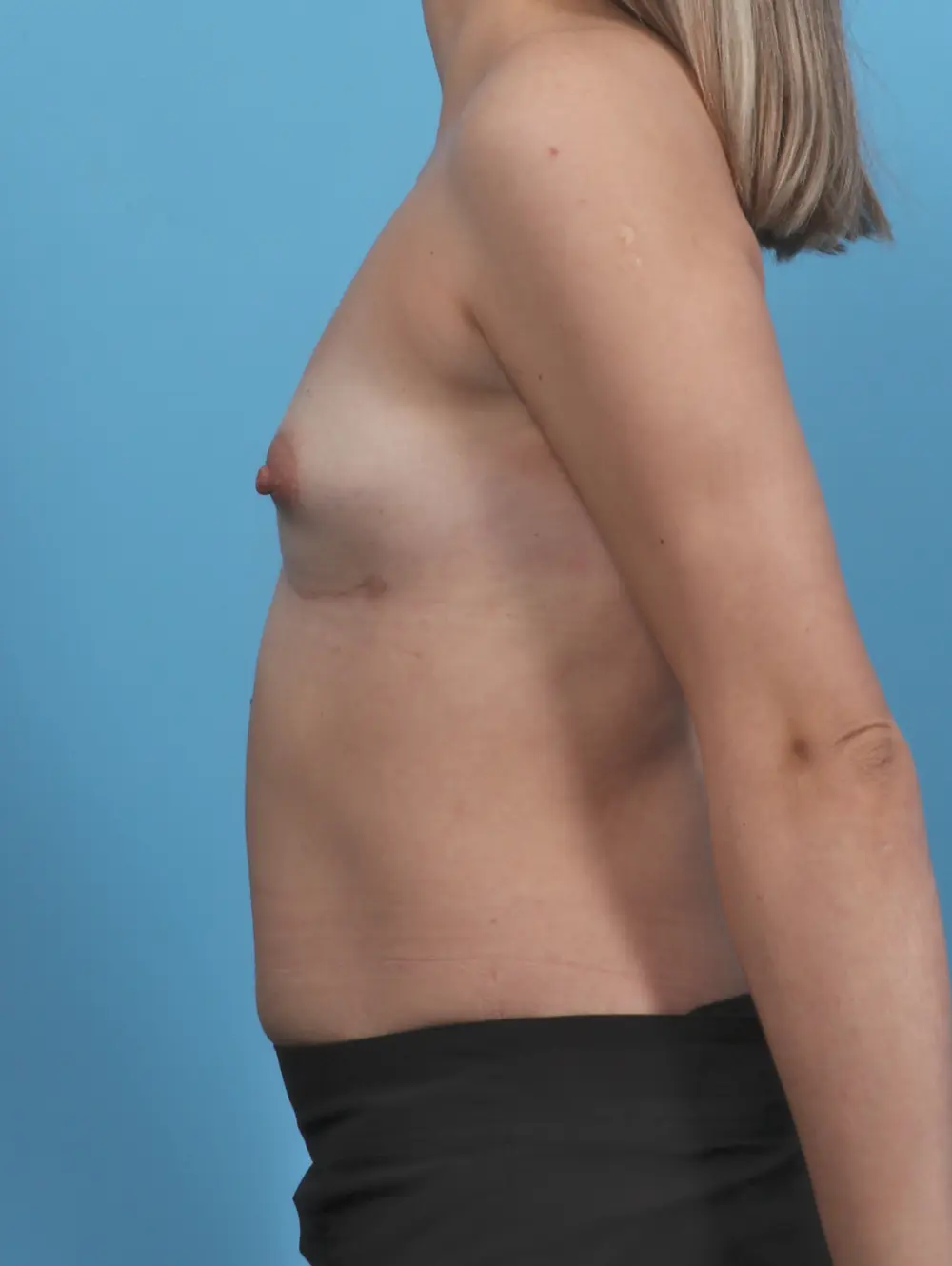 Breast Implant Removal Patient Photo - Case 46396 - after view-2