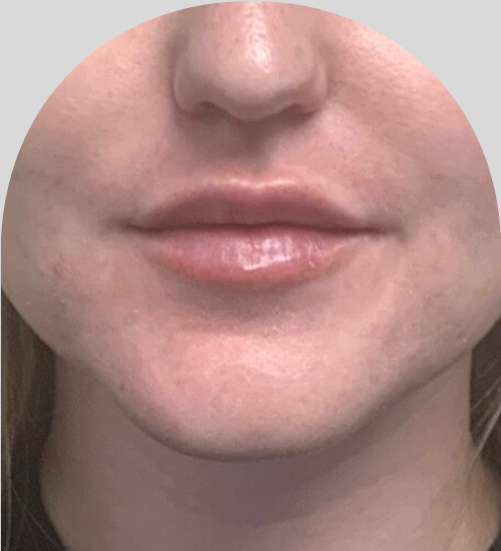 Lip Fillers - Case 46436 - After