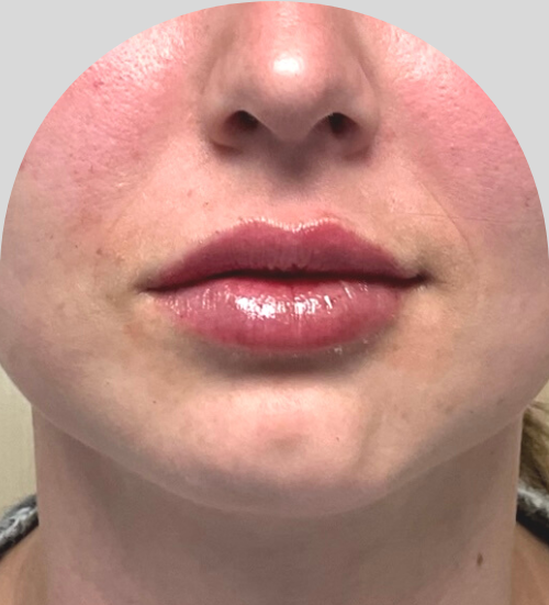 Lip Fillers - Case 46448 - After