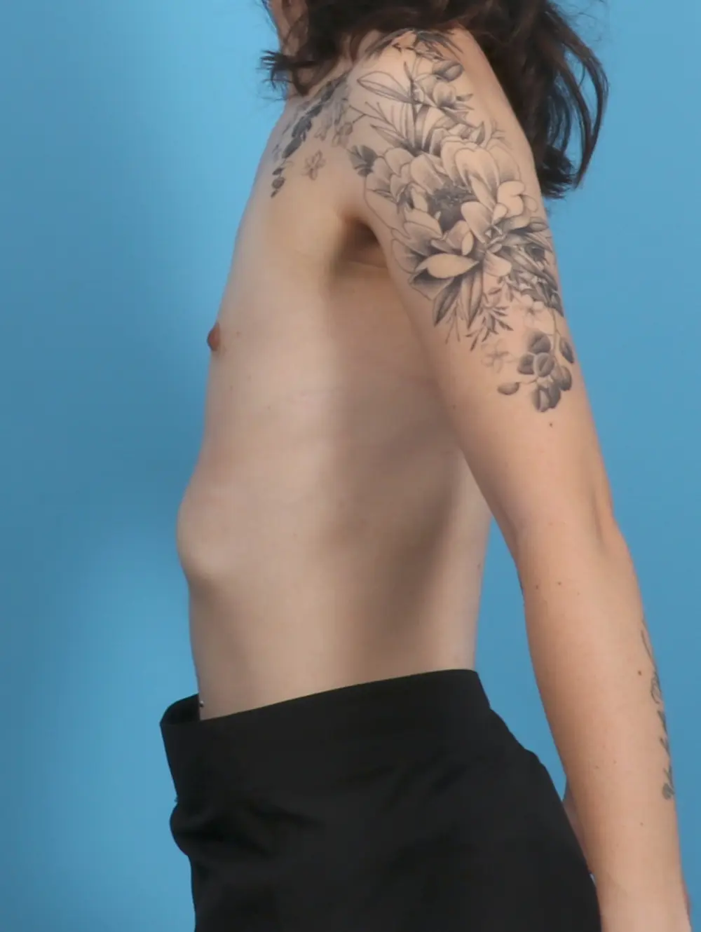 Breast Augmentation Patient Photo - Case 46453 - before view-2