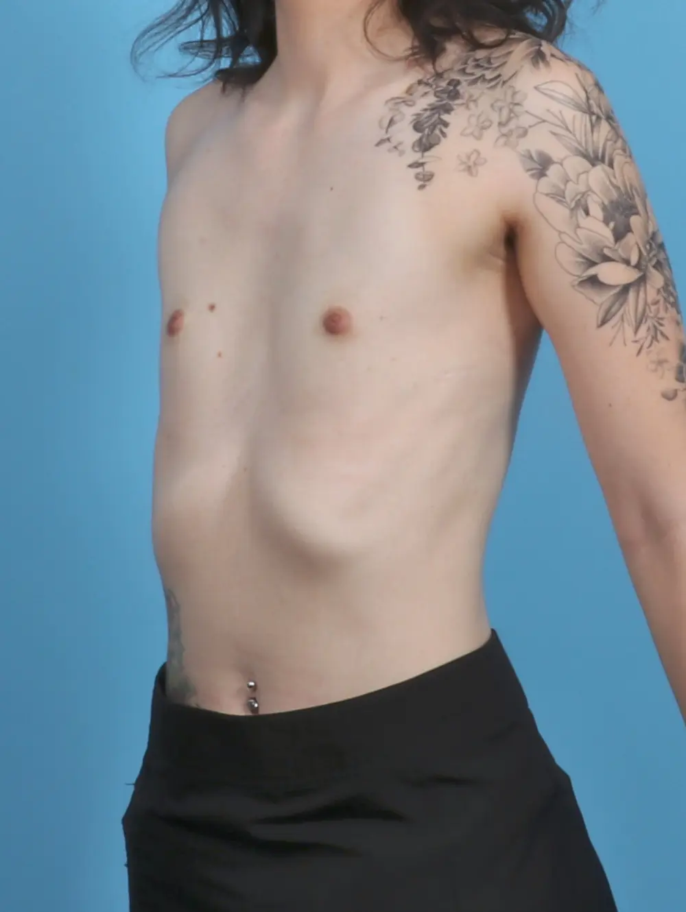 Breast Augmentation Patient Photo - Case 46453 - before view-1