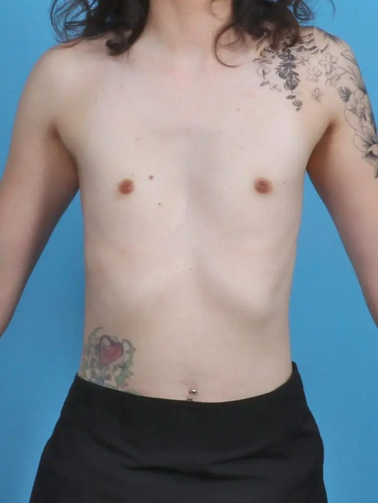 Breast Augmentation - Case 46453 - Before