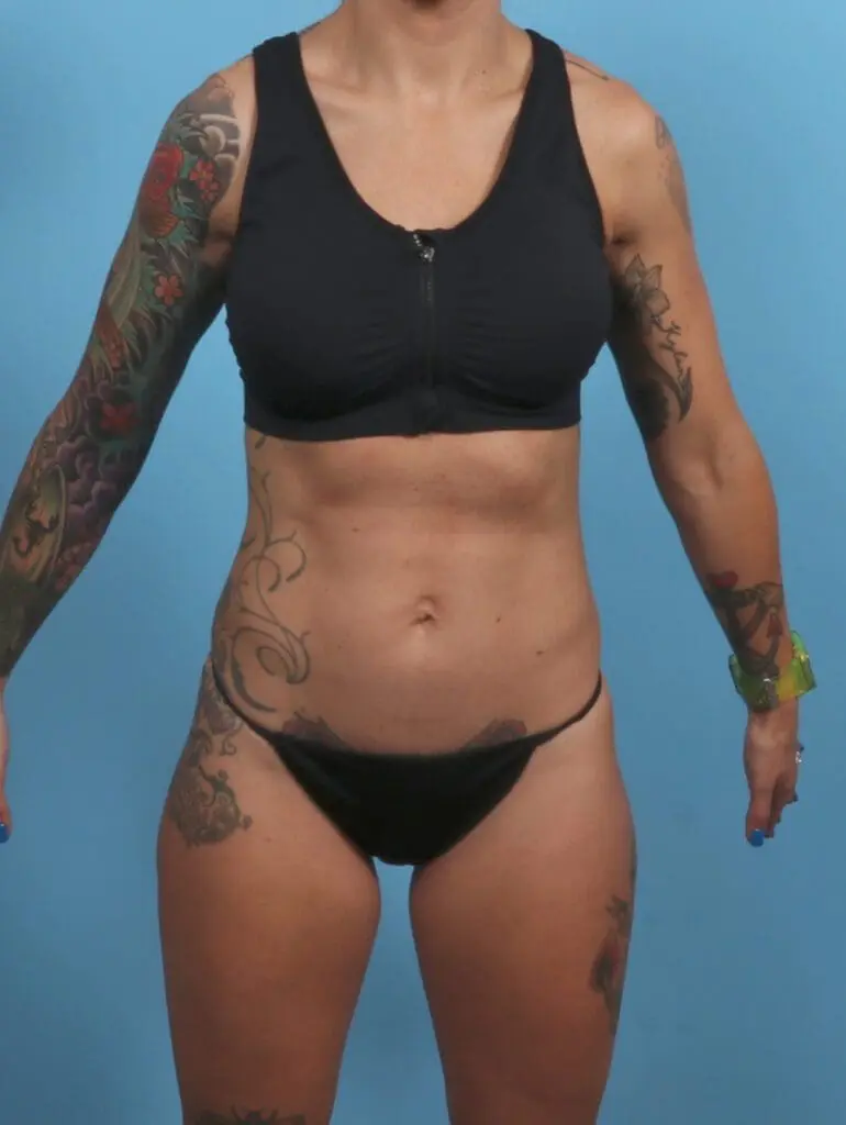 Tummy Tuck - Case 46461 - Before