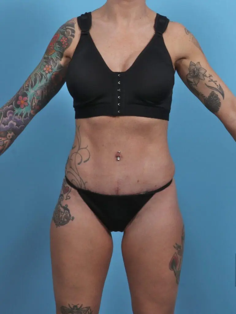 Tummy Tuck - Case 46461 - After