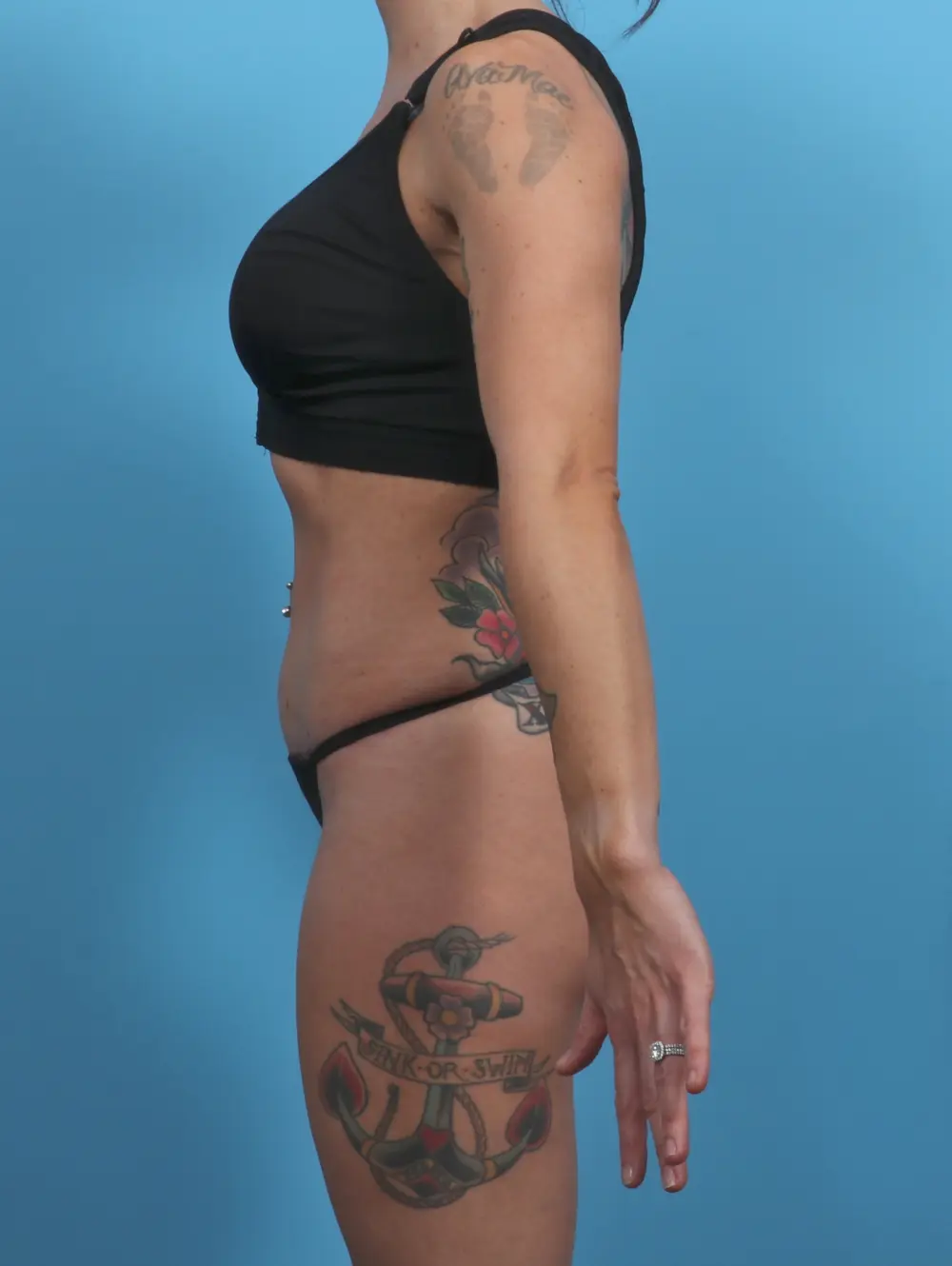 Tummy Tuck Patient Photo - Case 46461 - after view-2