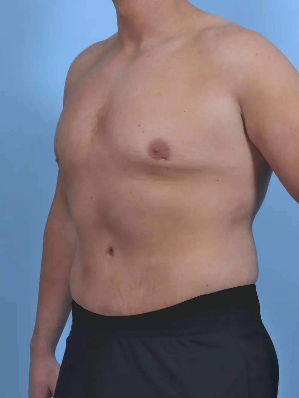 Male Body Lift Patient Photo - Case 46469 - after view-1