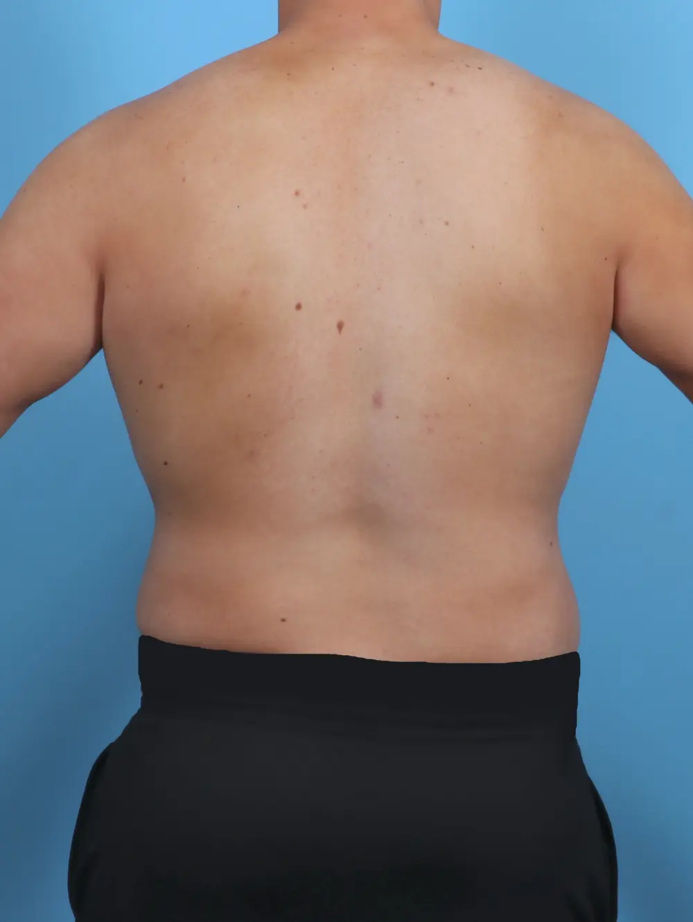 Male Body Lift Patient Photo - Case 46469 - after view-3