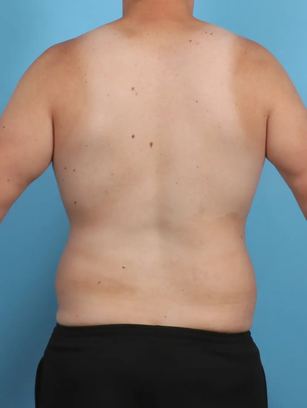 Male Body Lift Patient Photo - Case 46469 - before view-3