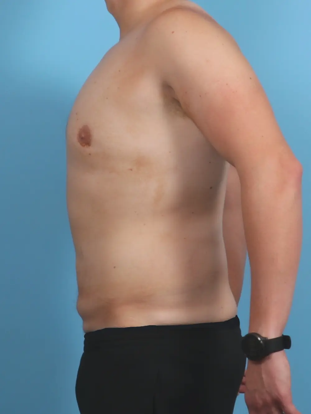 Male Body Lift Patient Photo - Case 46469 - before view-2