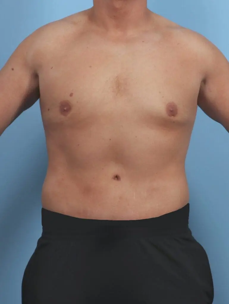 Male Body Lift - Case 46469 - After