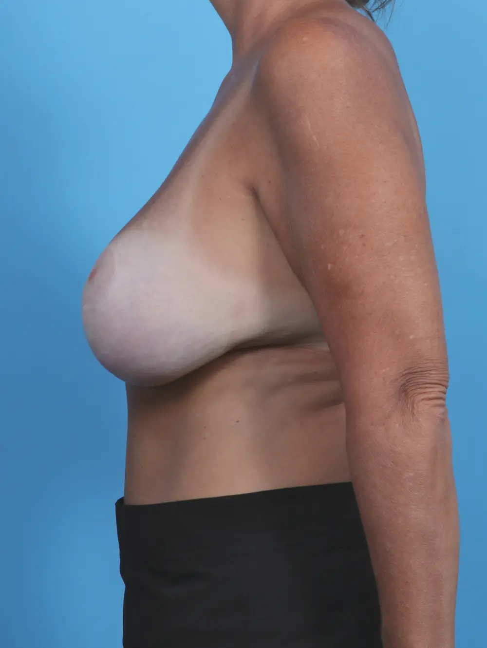 Breast Lift/Reduction with Implants Patient Photo - Case 46479 - before view-2