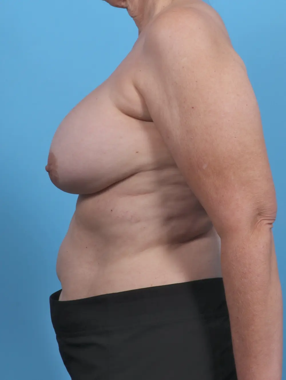 Breast Implant Revision Patient Photo - Case 46495 - after view-2