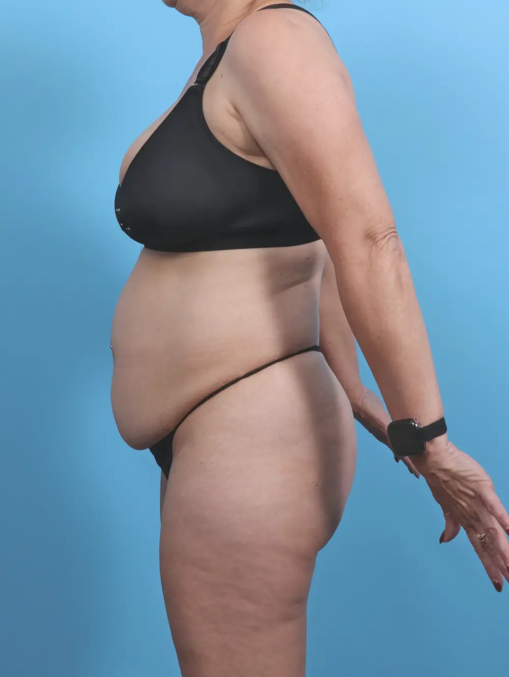 Tummy Tuck Patient Photo - Case 46511 - before view-2