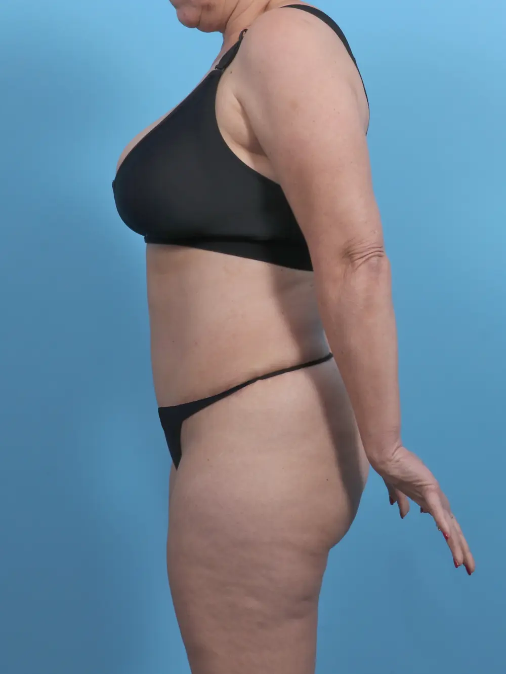 Tummy Tuck Patient Photo - Case 46511 - after view-2