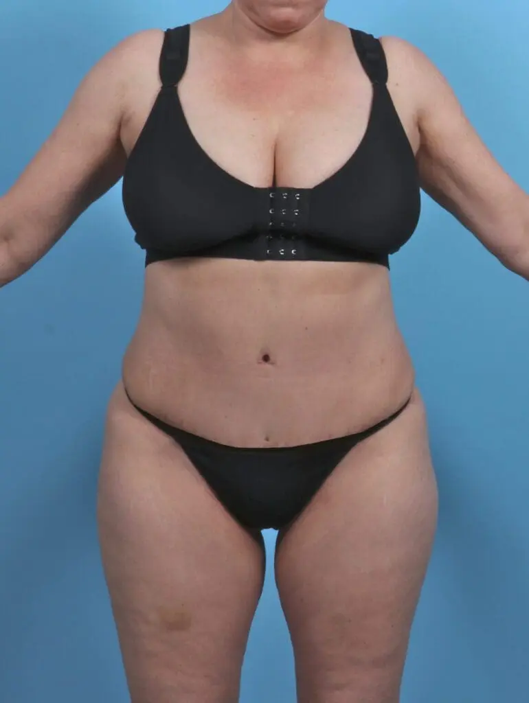 Tummy Tuck - Case 46511 - After