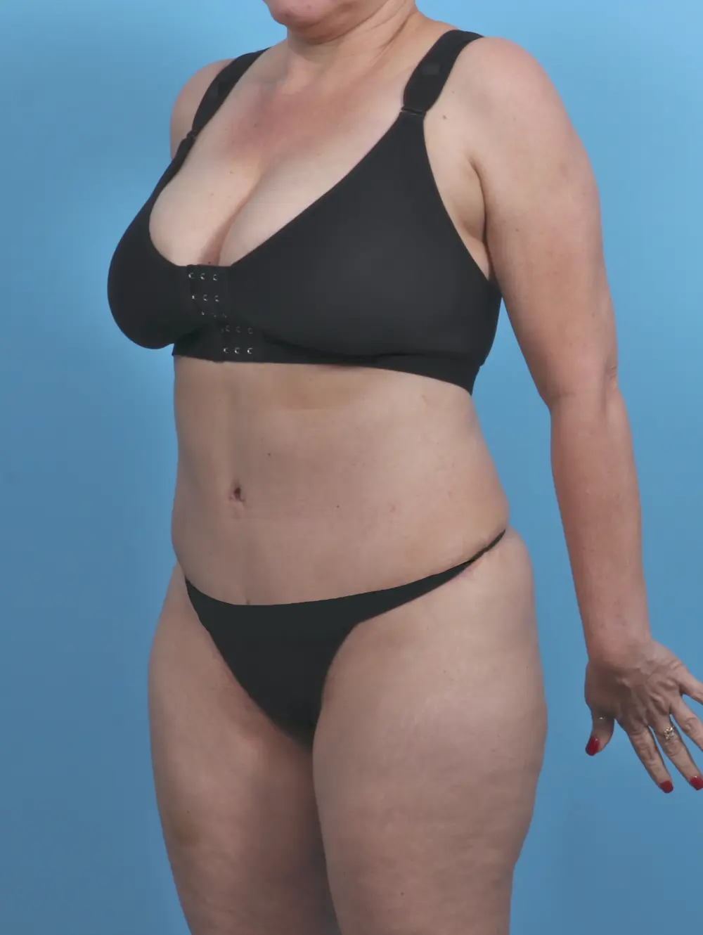 Tummy Tuck Patient Photo - Case 46511 - after view-1