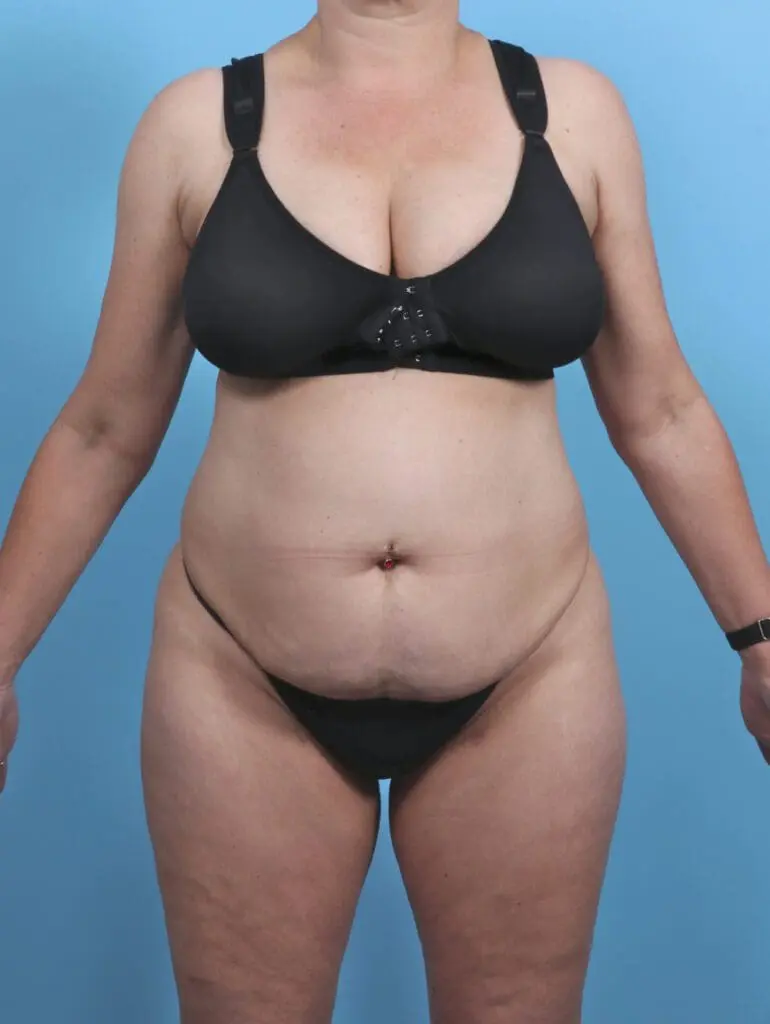 Tummy Tuck - Case 46511 - Before