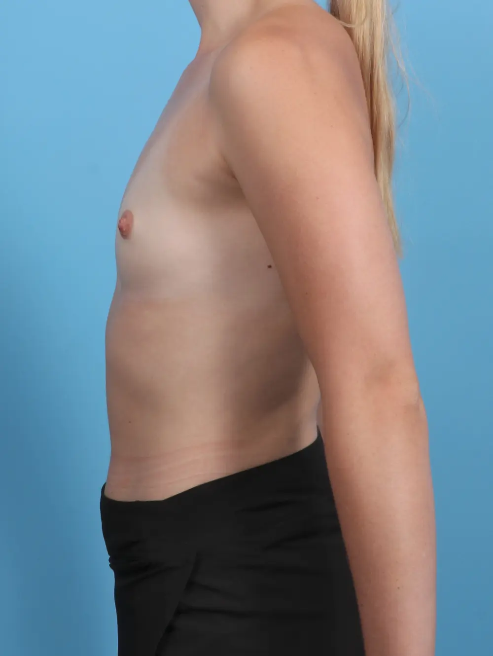 Breast Augmentation Patient Photo - Case 46521 - before view-2