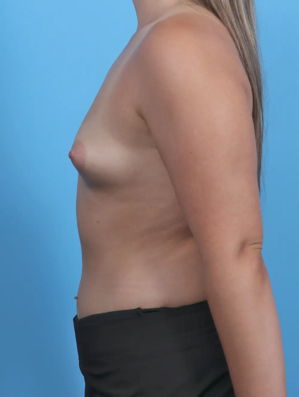 Breast Augmentation Patient Photo - Case 46537 - before view-2