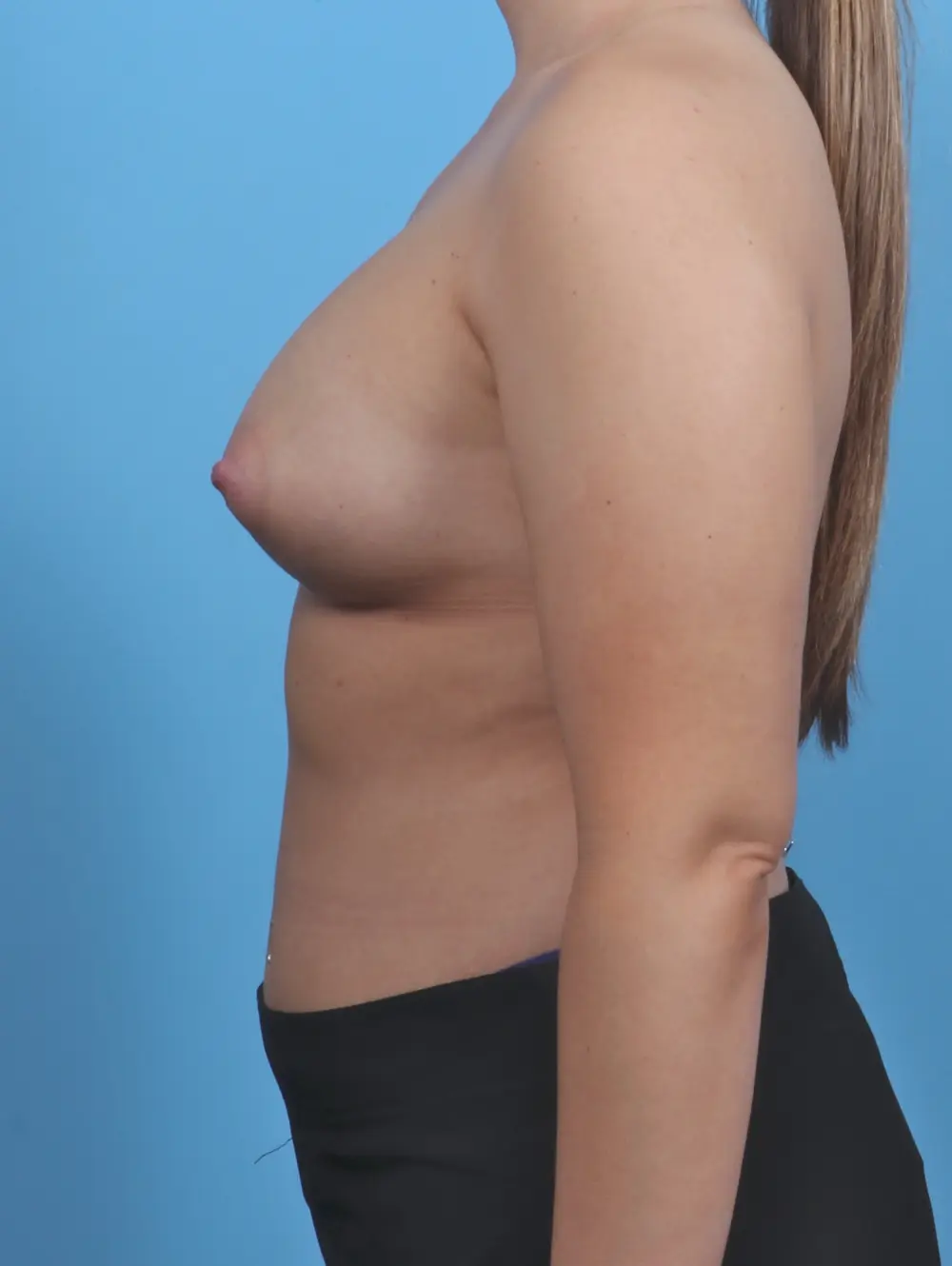 Breast Augmentation Patient Photo - Case 46537 - after view-2