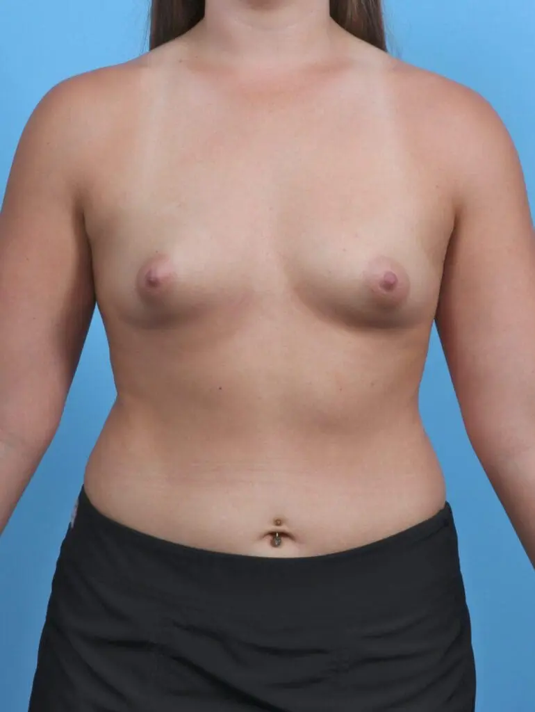 Breast Augmentation - Case 46537 - Before