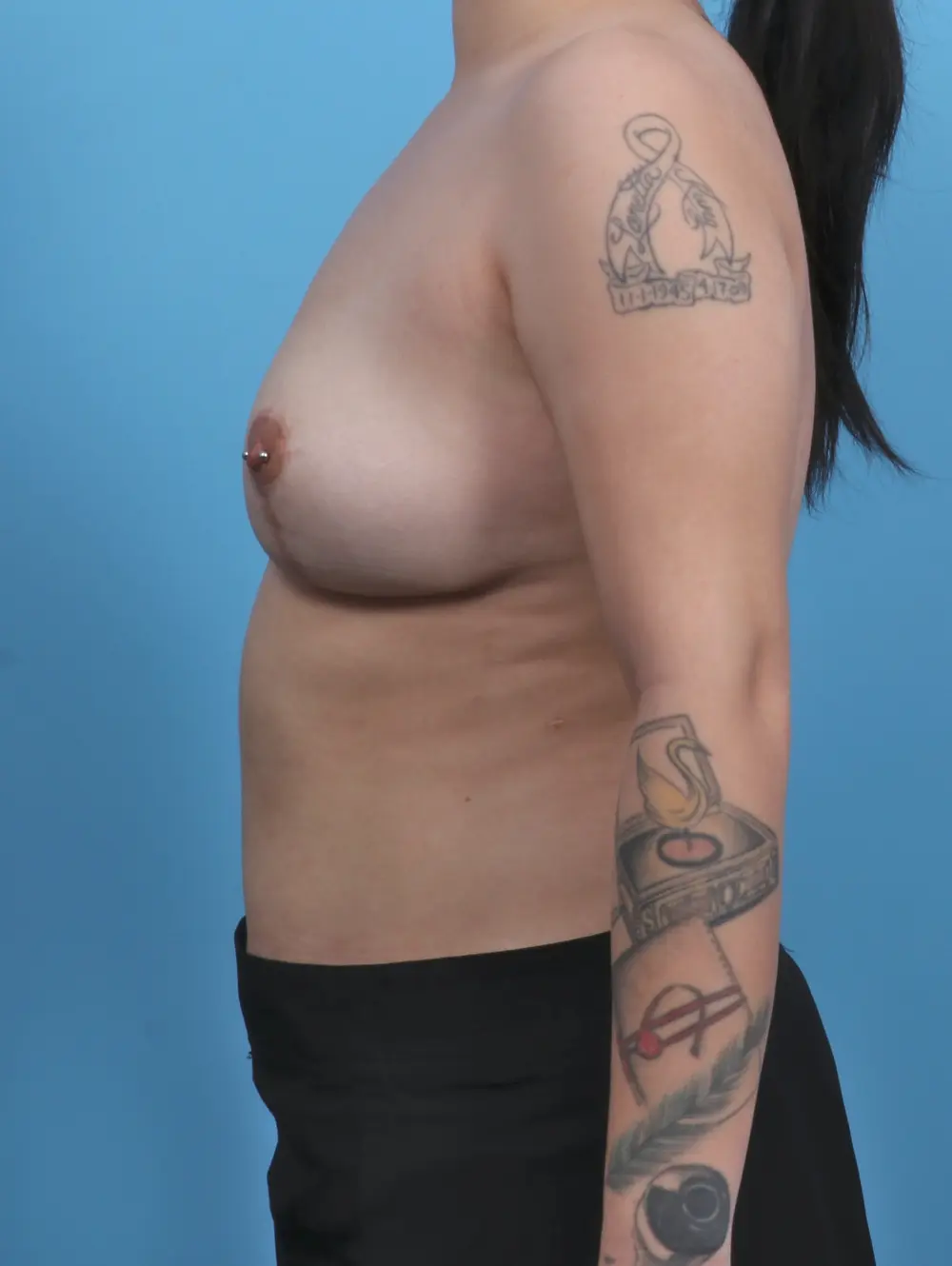 Breast Implant Removal Patient Photo - Case 46545 - after view-2