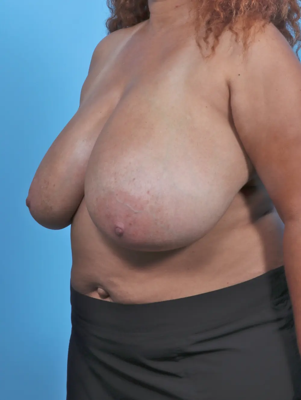Breast Lift/Reduction w/o Implants Patient Photo - Case 46553 - before view-1