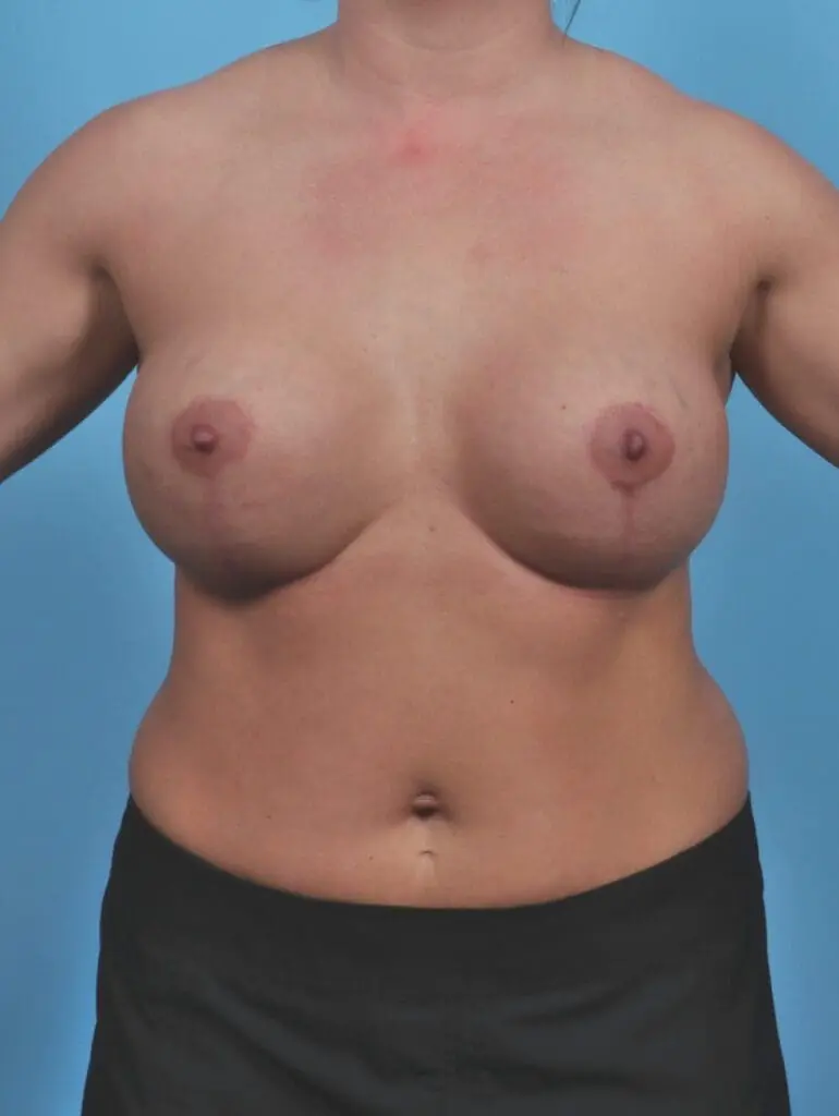 Breast Lift/Reduction with Implants - Case 46569 - After