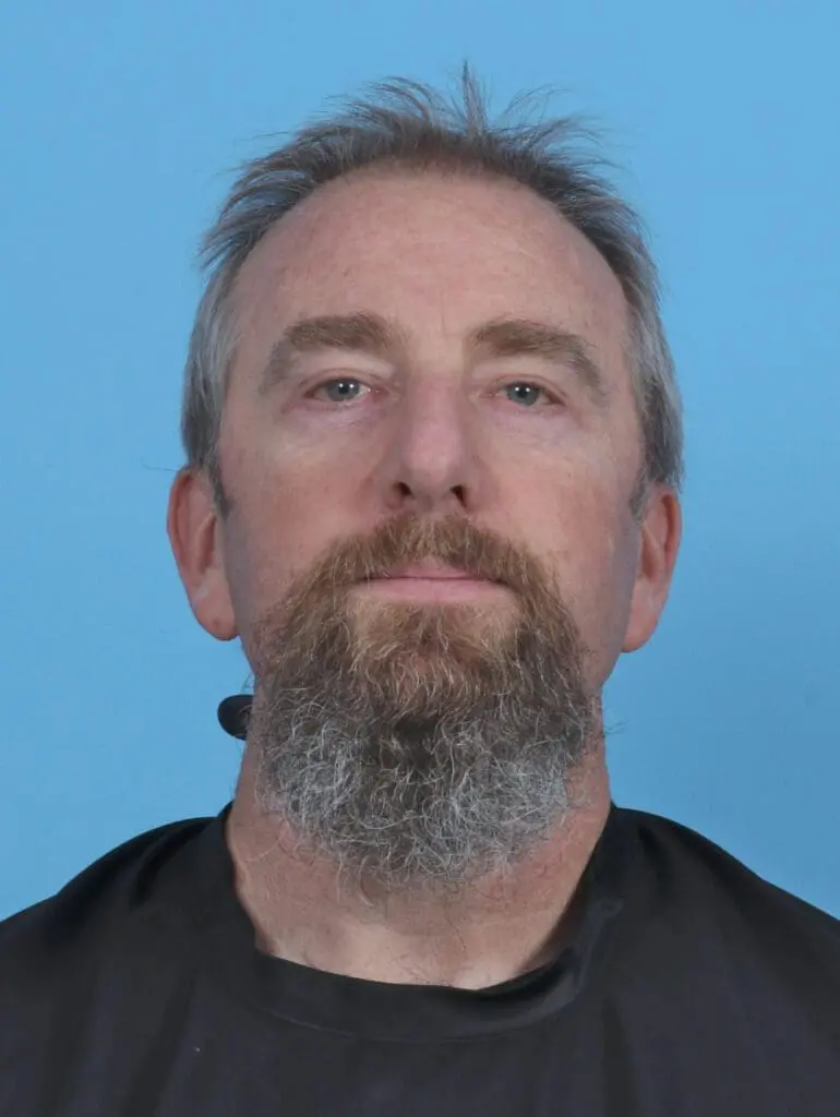 Eyelid Surgery - Case 46593 - After