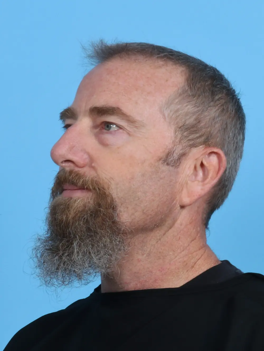 Eyelid Surgery Patient Photo - Case 46593 - before view-1