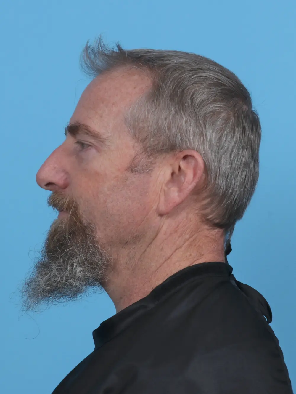 Eyelid Surgery Patient Photo - Case 46593 - after view-2