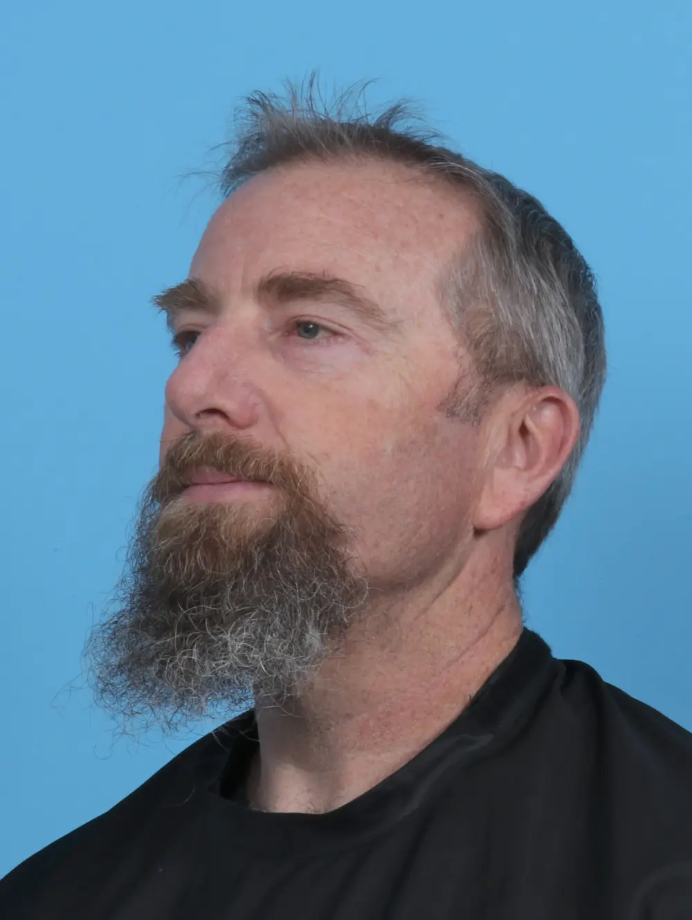 Eyelid Surgery Patient Photo - Case 46593 - after view-1