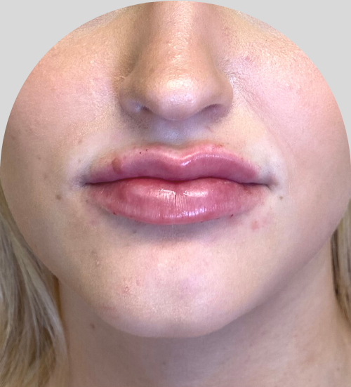 Lip Fillers - Case 46612 - After