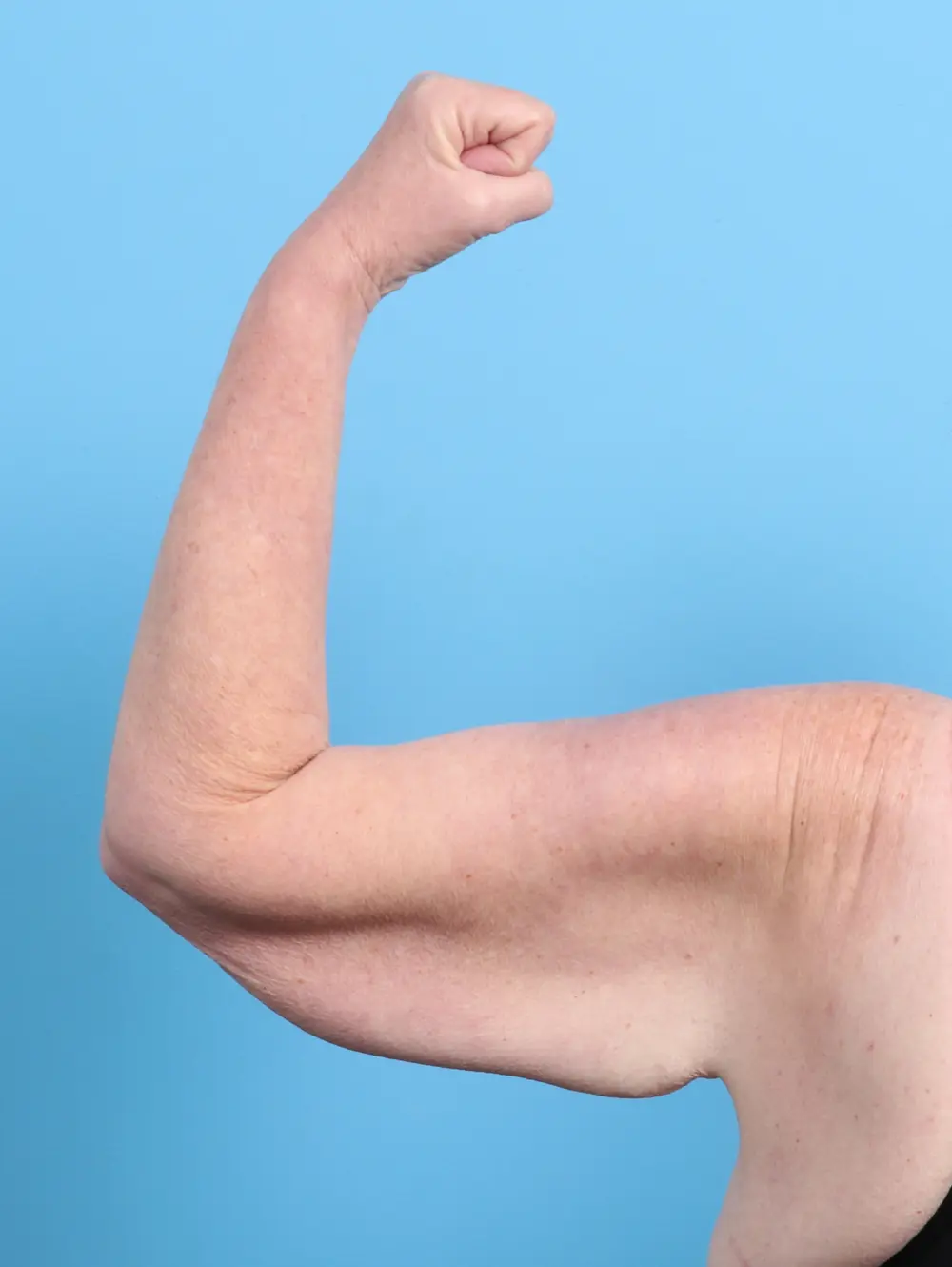 After Weight Loss Patient Photo - Case 46631 - before view-1