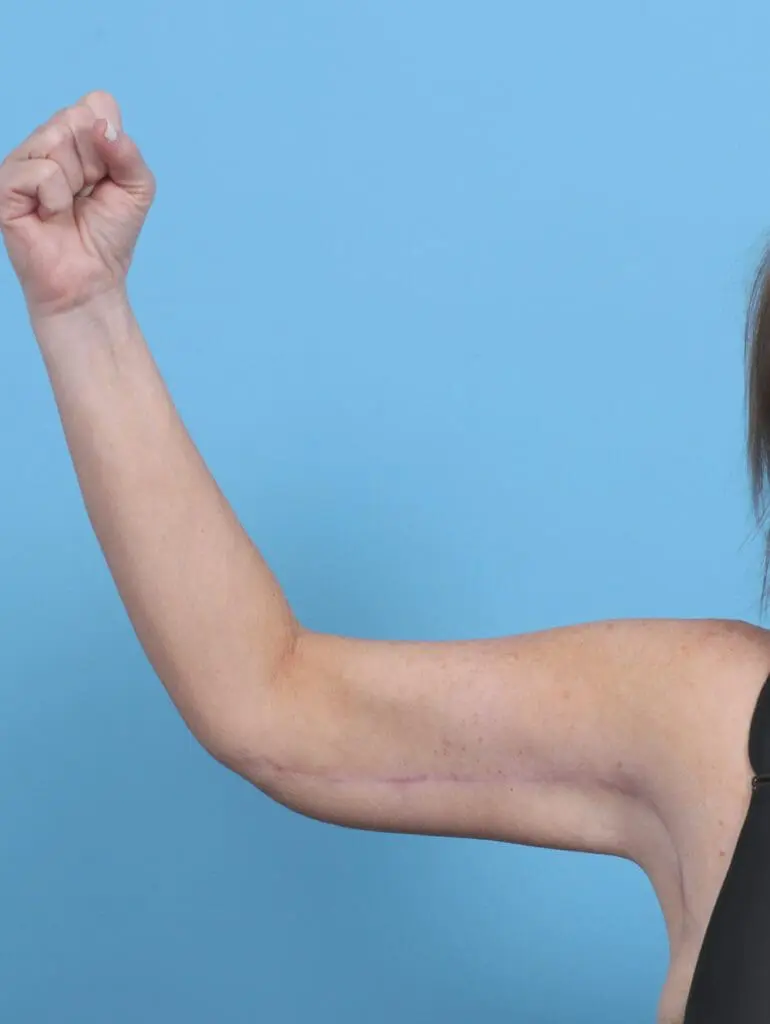 After Weight Loss - Case 46631 - After