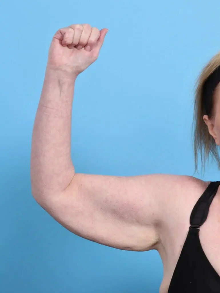 After Weight Loss - Case 46631 - Before